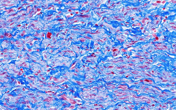 23G5 Neuroma (Case 23) Trichrome 40X 2