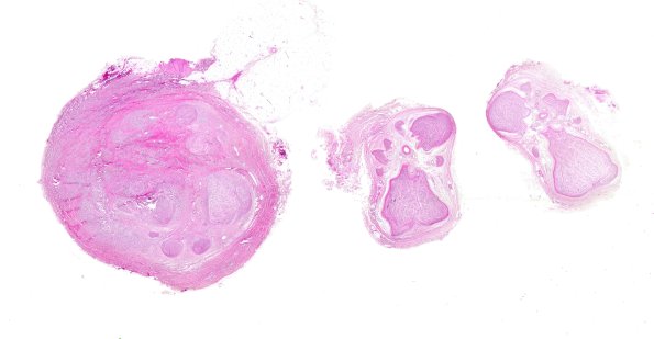 24A1 Neuroma (Case 24) H&E WM