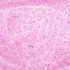 24A2 Neuroma (Case 24) H&E 10X