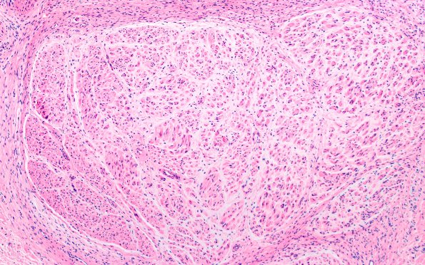 24A2 Neuroma (Case 24) H&E 10X