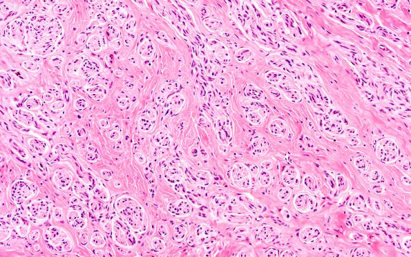 24A3 Neuroma (Case 24) H&E 20X