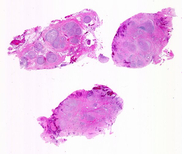 25A0 Nerve Trauma (Case 25) H&E 2X