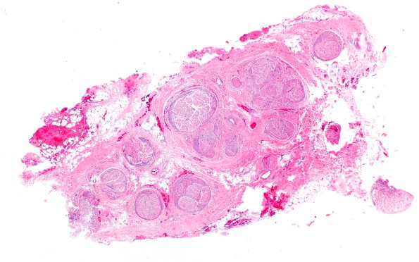 25A1 Nerve Trauma (Case 25) H&E 2X