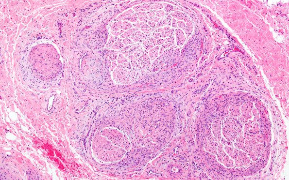 25A2 Nerve Trauma (Case 25) H&E 10X 2