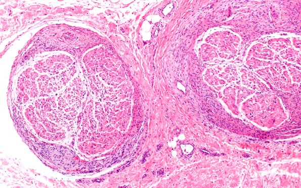 25A3 Nerve Trauma (Case 25) H&E 10X 1