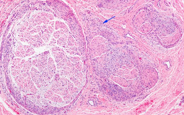 25A5 Nerve Trauma (Case 25) H&E 10X copy