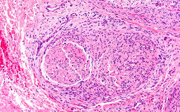 25A7 Nerve Trauma (Case 25) H&E 20X 1