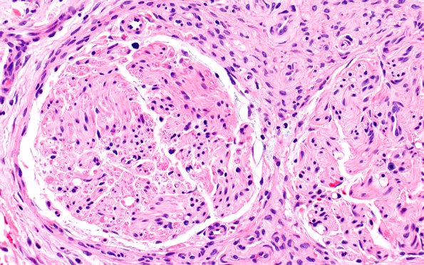 25A8 Nerve Trauma (Case 25) H&E 40X 1