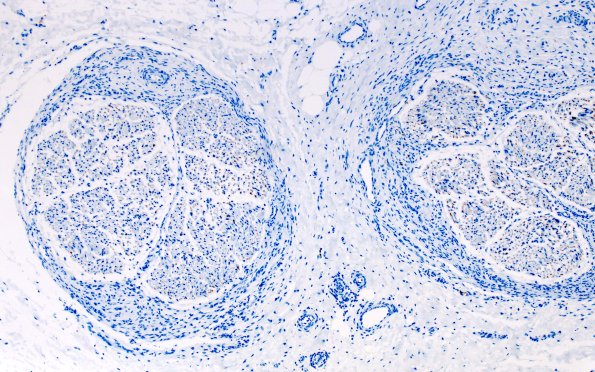 25B1 Nerve Trauma (Case 25) NF 10X 3A