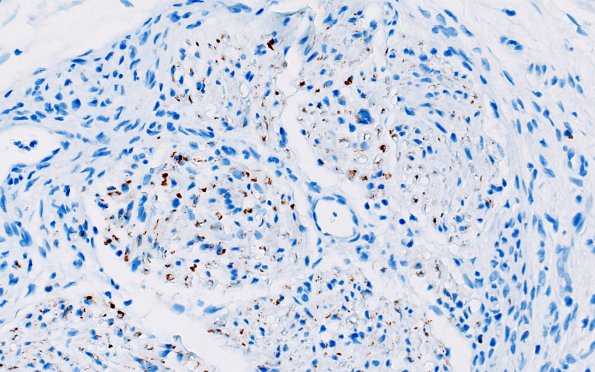 25B2 Nerve Trauma (Case 25) NF 40X 4