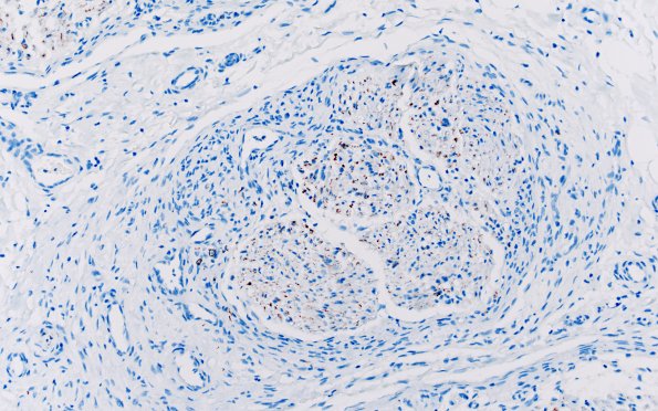 25B5 Nerve Trauma (Case 25) NF 20X 3