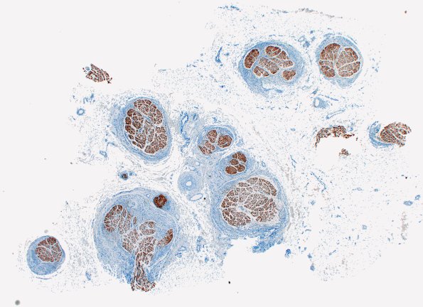 25C1 Nerve Trauma (Case 25) S100 2X 1A