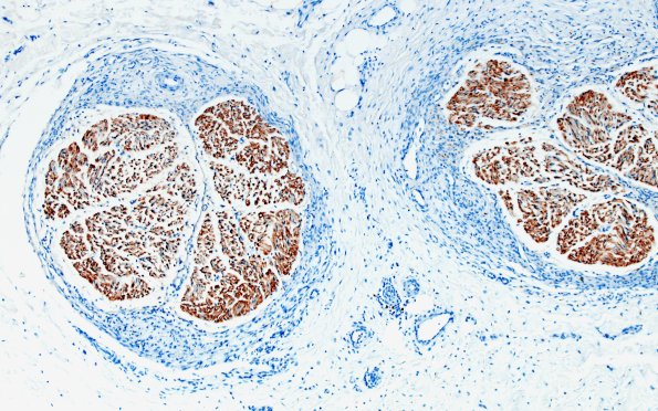 25C2 Nerve Trauma (Case 25) S100 10X 1A