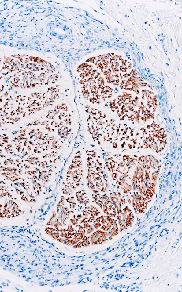 25C3 Nerve Trauma (Case 25) S100 20X 3A
