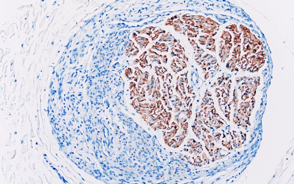 25C4 Nerve Trauma (Case 25) S100 20X 1