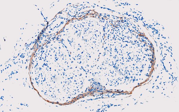 25D1 Nerve Trauma (Case 25) EMA 20X 1A