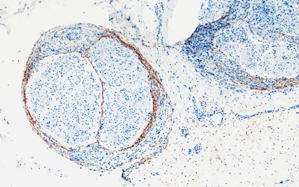 25D2 Nerve Trauma (Case 25) EMA 10X 1A