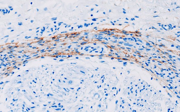 25D2A Nerve Trauma (Case 25) EMA 40X 1