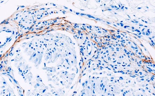 25D3 Nerve Trauma (Case 25) EMA 40X 3