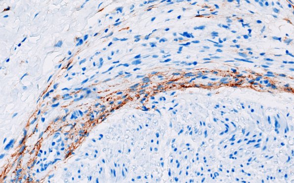 25D4 Nerve Trauma (Case 25) EMA 40X 2