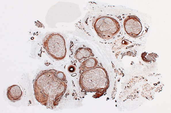 25E1 Nerve Trauma (Case 25) Coll IV 2X 1