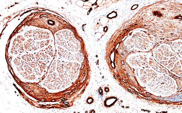 25E2 Nerve Trauma (Case 25) Coll IV 10X 1a