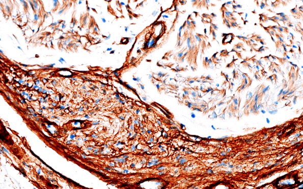 25E3 Nerve Trauma (Case 25) Coll IV 40X 1A
