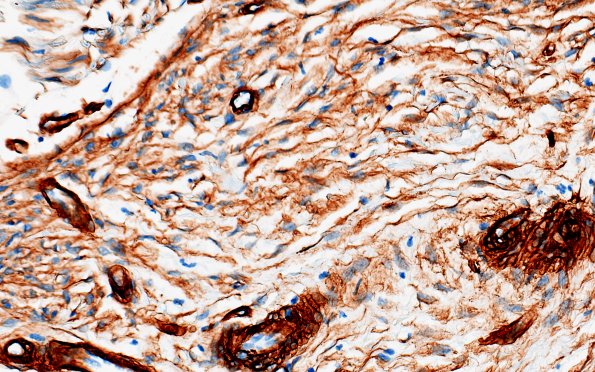 25E5 Nerve Trauma (Case 25) Coll IV 40X 3