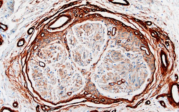 25E6 Nerve Trauma (Case 25) Coll IV 20X 1