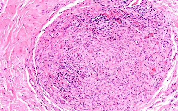 25F2 Nerve Trauma (Case 25) H&E 20X 2
