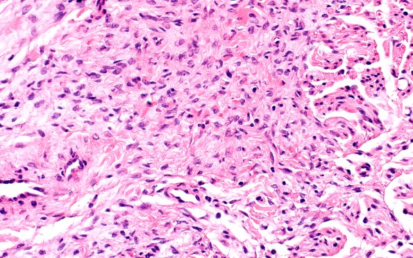 25F4 Nerve Trauma (Case 25) H&E 40X