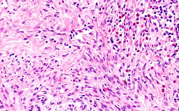 25F5 Nerve trauma (Case 25) H&E 40X (2)