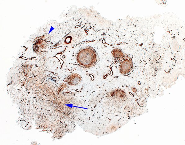 25G1 Nerve Trauma (Case 25) Coll IV 2X copy
