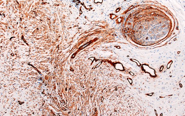 25G2 Nerve Trauma (Case 25) Coll IV 10X 1