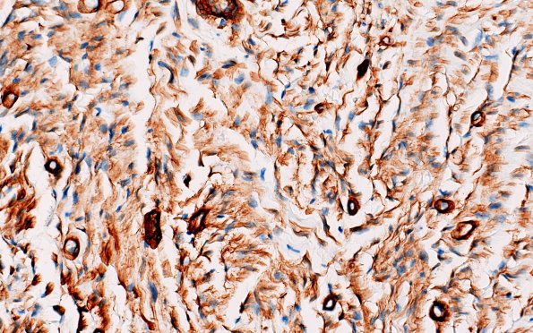 25G3 Nerve Trauma (Case 25) Coll IV 40X 4