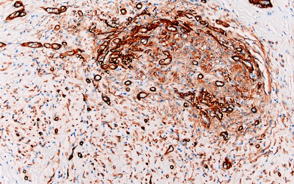 25G5 Nerve Trauma (Case 25) Coll IV 20X 3