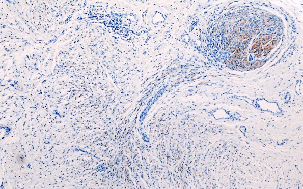 25H1 Nerve Trauma (Case 25) S100 20X