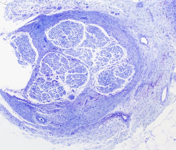 25I1 1 Nerve Trauma (Case 25) Plastic 10X 1
