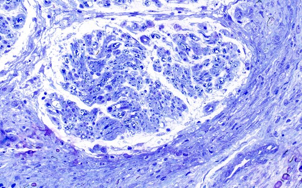 25I2 1 Nerve Trauma (Case 25) Plastic 20X 2