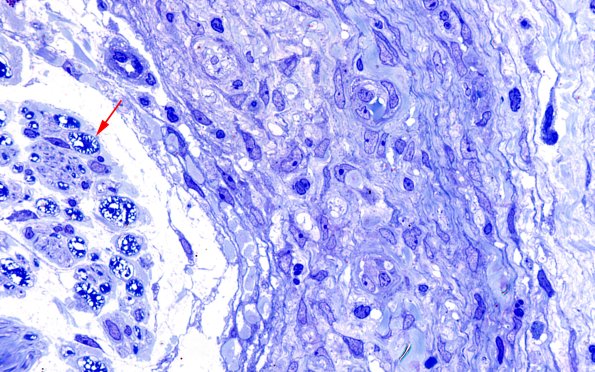 25I3 Nerve Trauma (Case 25) Plastic 100X 4 copy