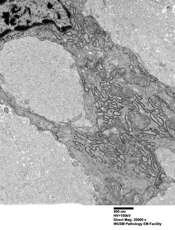26K2F (Case 26) Ulnar Nerve_103 - Copy