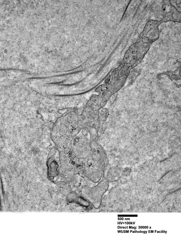 26K3E (Case 26) Ulnar Nerve_032 - Copy