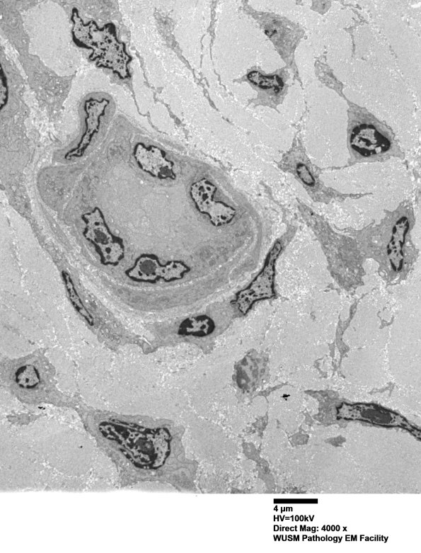 26L2 (Case 26) Ulnar Nerve_004 - Copy