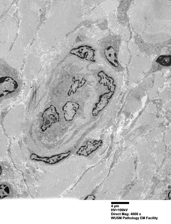 26L3 (Case 26) Ulnar Nerve_075 - Copy