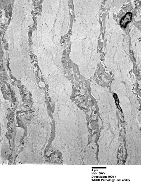 26M2 (Case 26) Ulnar Nerve_010 - Copy