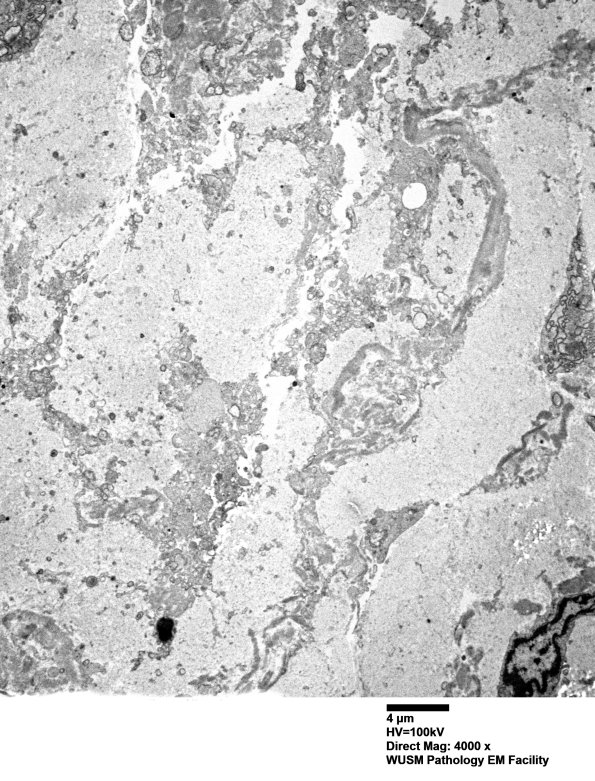 26M3 (Case 26) Ulnar Nerve_016 - Copy