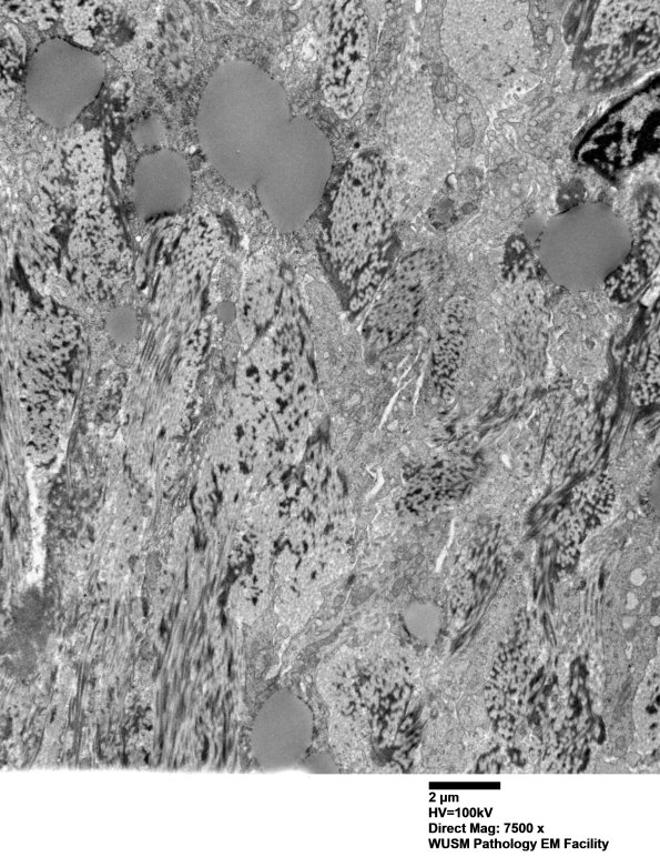 26M7 (Case 26) Ulnar Nerve_097 - Copy