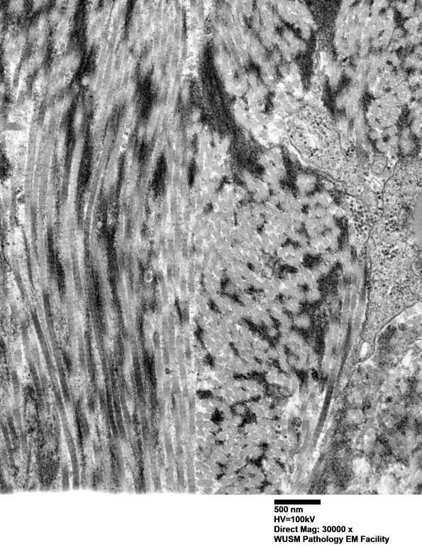 26M8 (Case 26) Ulnar Nerve_096 - Copy