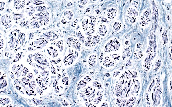 2A2 Neuroma (Case 2) Bodian 40X