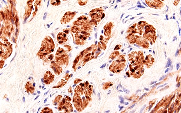 2B2 EMA vs S100 (Case 2) S100 60X 2